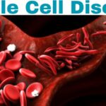 All You Need to Know About Sickle Cell Disease