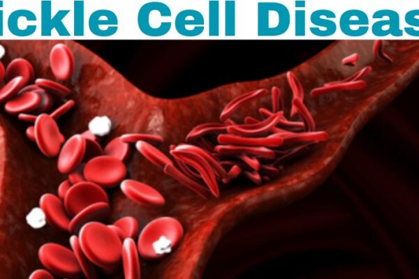 All You Need to Know About Sickle Cell Disease